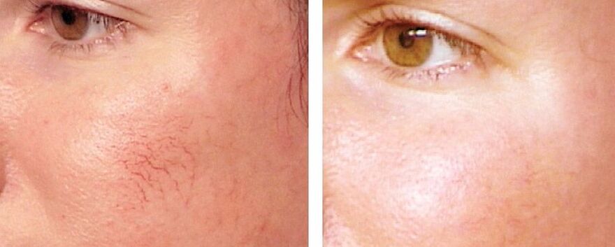Entfernung von Rosacea