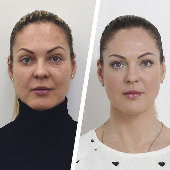 Vor und nach der Gesichtshautverjüngung ohne Operation