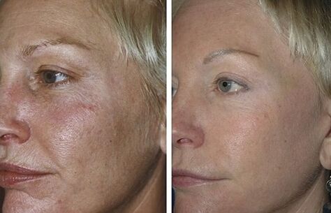 fraktionierte Laserverjüngung vor und nach Fotos