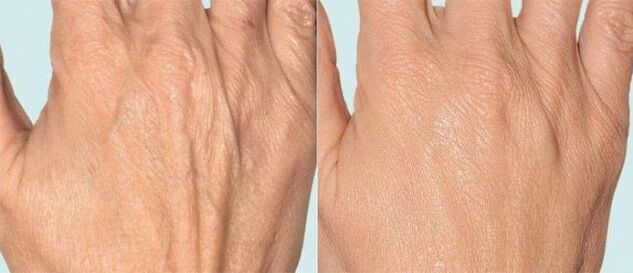 Handhaut vor und nach der fraktionierten Therapie